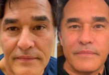 Luciano Szafir faz harmonização facial e gera revolta nas redes: ‘Era tão bonito’