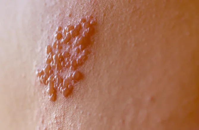 herpes-zoster-vacina-previne-dor-cronica-e-lesoes-0140494100202610071531